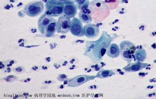 非典型鳞状细胞不除外高级别鳞状上皮内病变（atypical squamous cell cannot exclude HSIL, ASC-H）