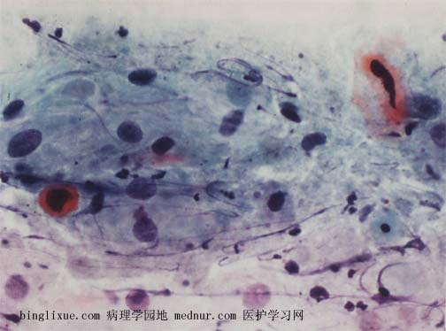 非典型鳞状细胞不除外高级别鳞状上皮内病变（atypical squamous cell cannot exclude HSIL, ASC-H）