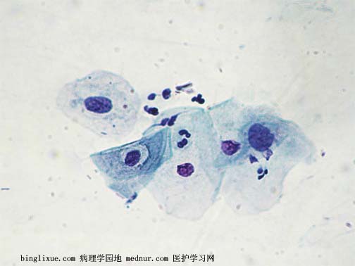 非典型鳞状细胞、意义不明确（ASC-US）