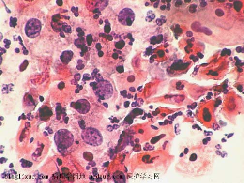 角化型鳞状细胞癌 (keratinizing squamous cell carcinoma )