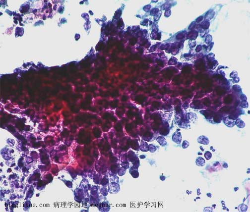 非角化型鳞状细胞癌 (nonkeratinizing squamous cell carcinoma)