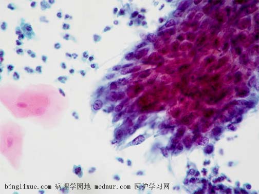 非角化型鳞状细胞癌 (nonkeratinizing squamous cell carcinoma)