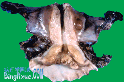 子宫颈癌 (外生菜花型):宫颈外口癌组织呈菜花状突起