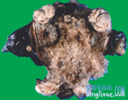 侵蚀性葡萄胎(invasive mole)